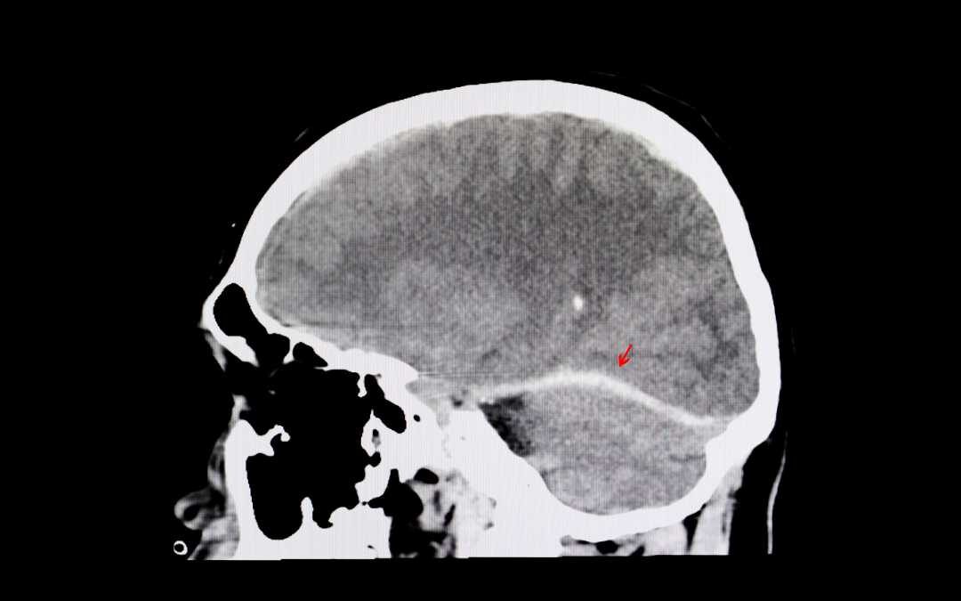 Traumatic Brain Injury Symptoms May Last for Years